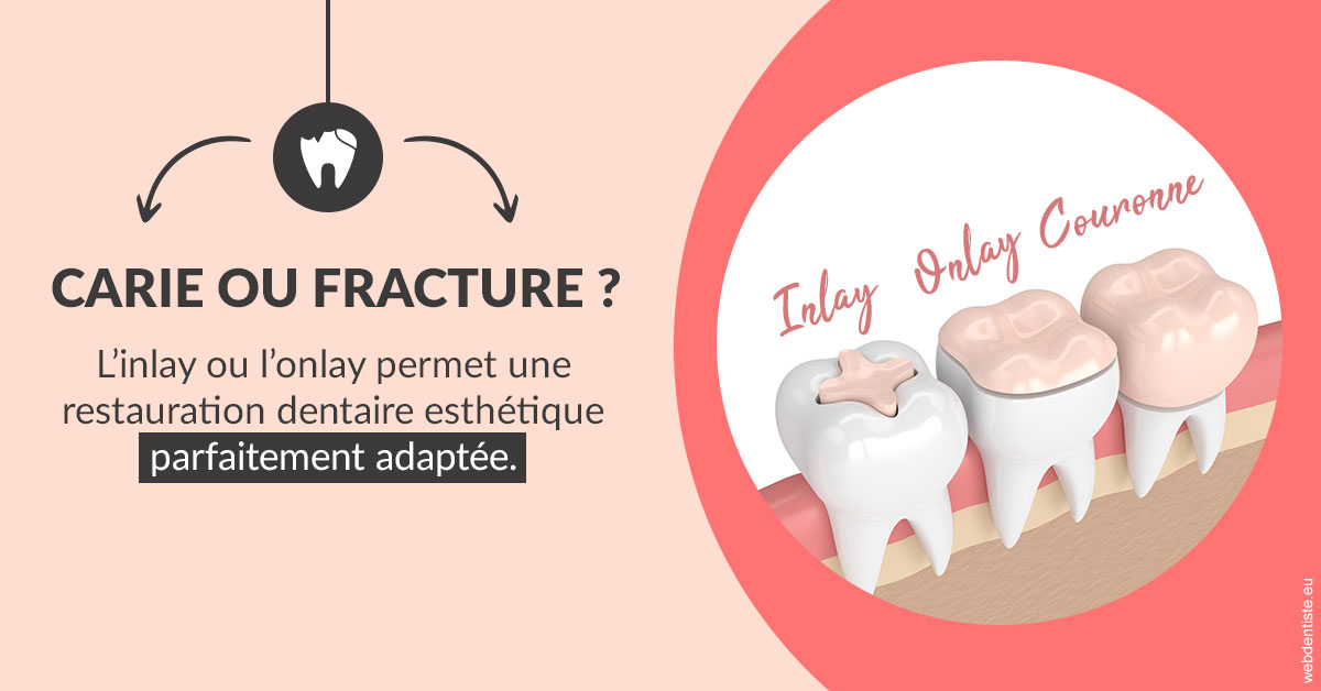 https://dr-aouizerat-david.chirurgiens-dentistes.fr/T2 2023 - Carie ou fracture 2