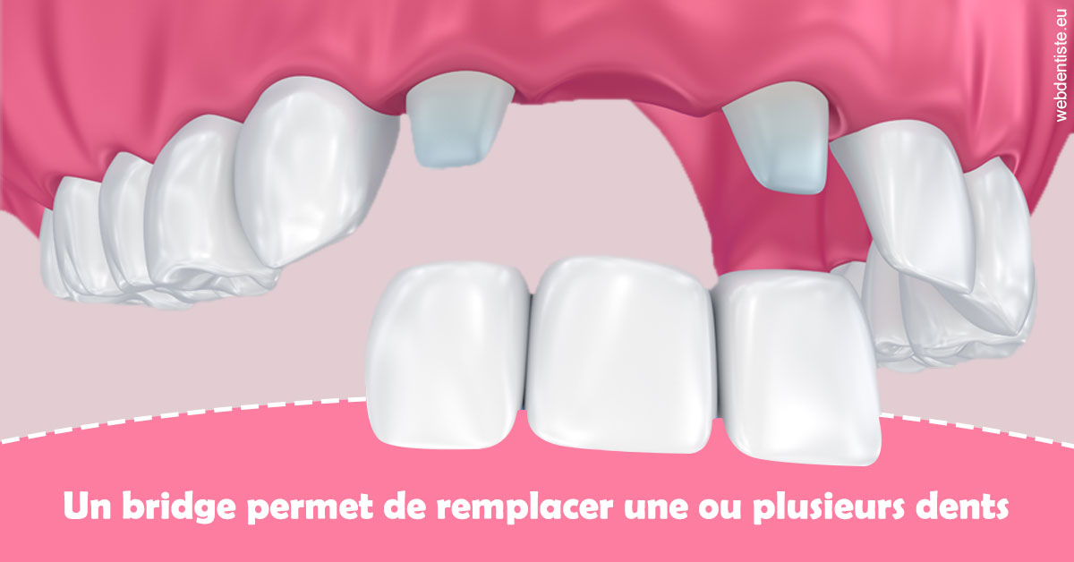 https://dr-aouizerat-david.chirurgiens-dentistes.fr/Bridge remplacer dents 2