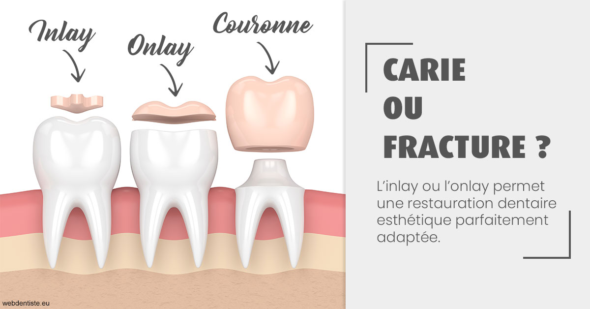 https://dr-aouizerat-david.chirurgiens-dentistes.fr/T2 2023 - Carie ou fracture 1
