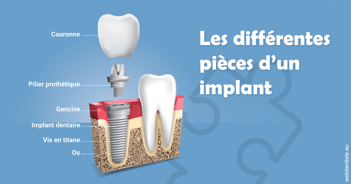 https://dr-aouizerat-david.chirurgiens-dentistes.fr/Les différentes pièces d’un implant 1